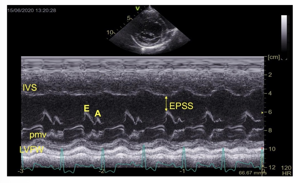 <p>E point to septal separation</p>