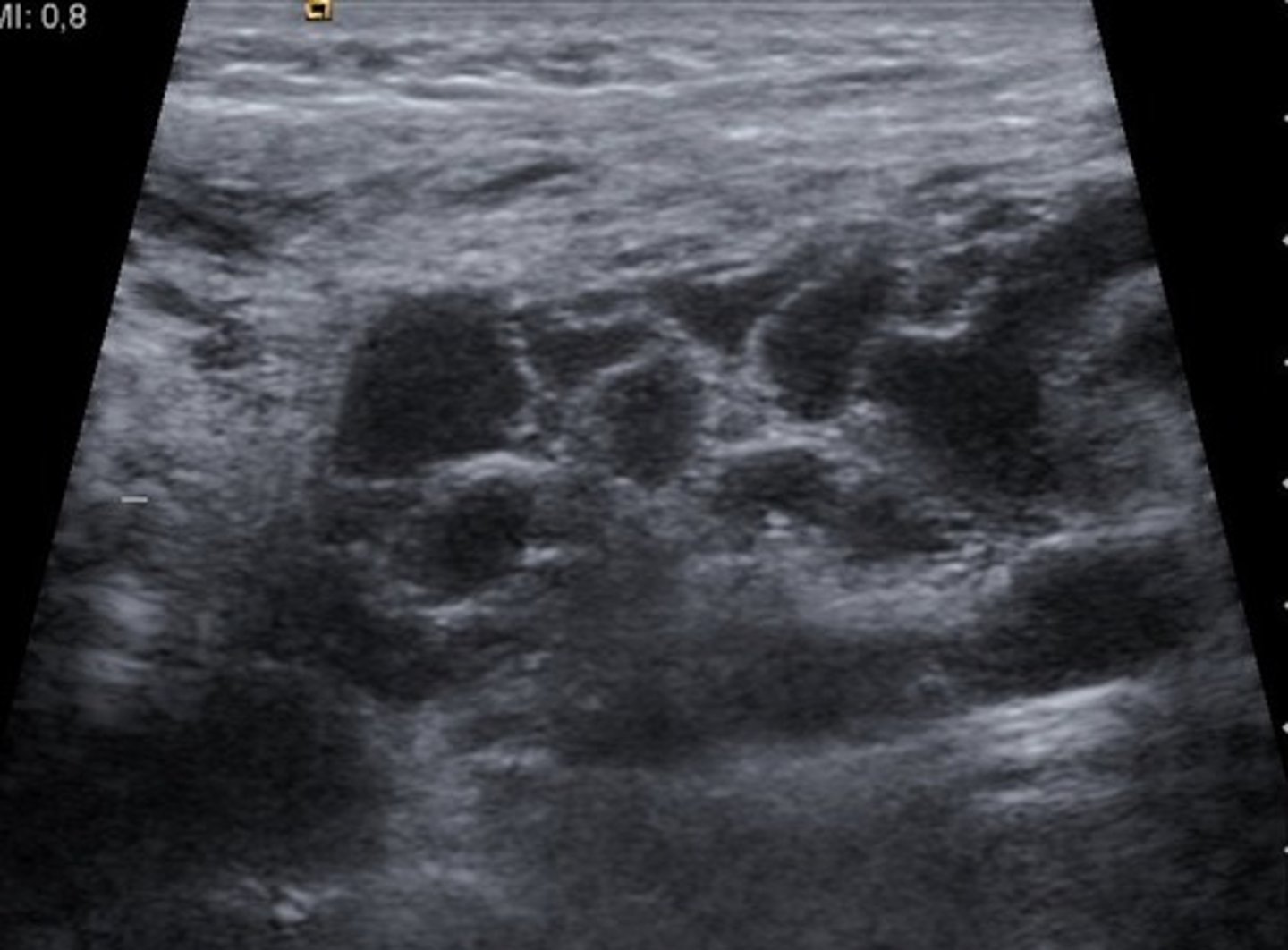 <p>Congenital lymphatic malformation</p><p>Webbed neck</p><p>Associated with chromosomal anomalies</p>