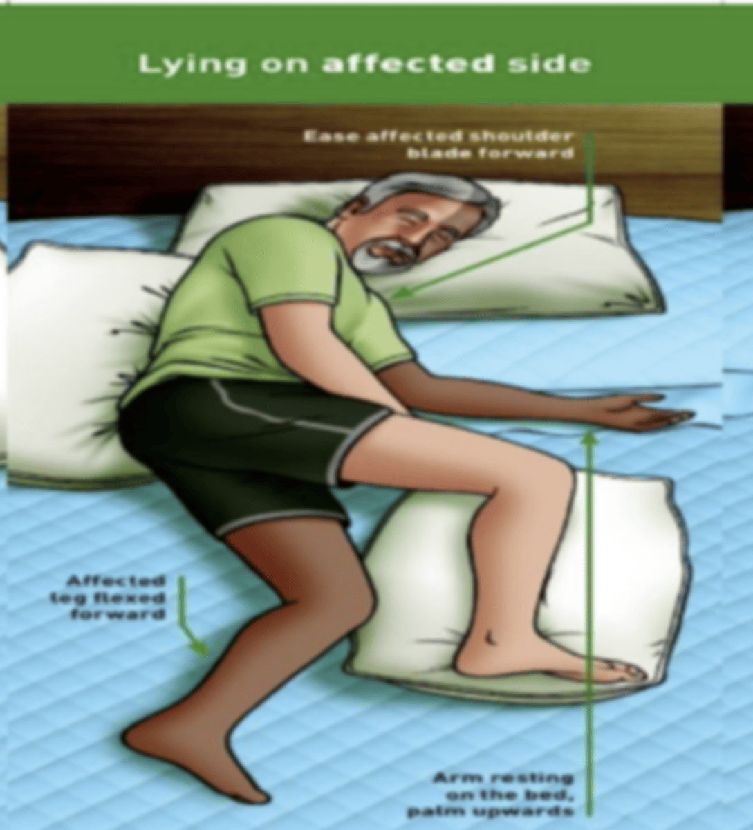 <p>Head/neck: neutral</p><p>Trunk: midline</p><p>More affected UE:</p><p>-Scapular protraction</p><p>-Shoulder forward</p><p>-Arm in slight ABD and ER</p><p>-Elbow extended</p><p>-Forearm supinated</p><p>-neutral wrist, fingers extended and thumb ABD</p><p>More affected LE:</p><p>-Hip extended</p><p>-Knee flexed and supported by pillows</p><p>(Alt: slight hip and knee flexion with pelvic rotation)</p>