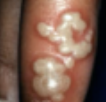 <p>Configuration of Skin Lesion</p><ul><li><p>Localized in <strong>one small body area, merge</strong></p></li></ul><p></p>