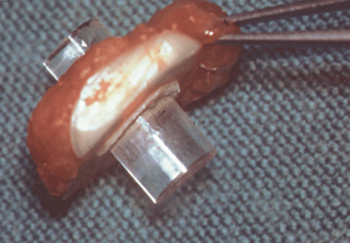 <p>What is the Osteo-Odonto-Keratoprosthesis (OOKP)?</p>