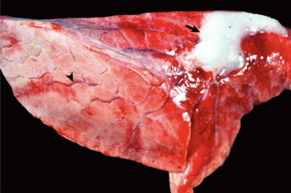 <p>What clinical syndrome is this associated with?</p>