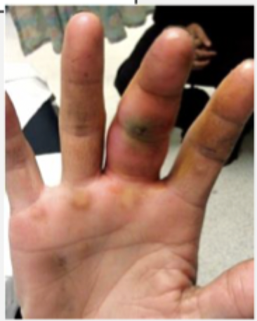 <p>A infection along the flexor tendon sheath that can be caused by penetrating trauma over the volar side OR a spread from felon, septic joint, or deep infection</p>