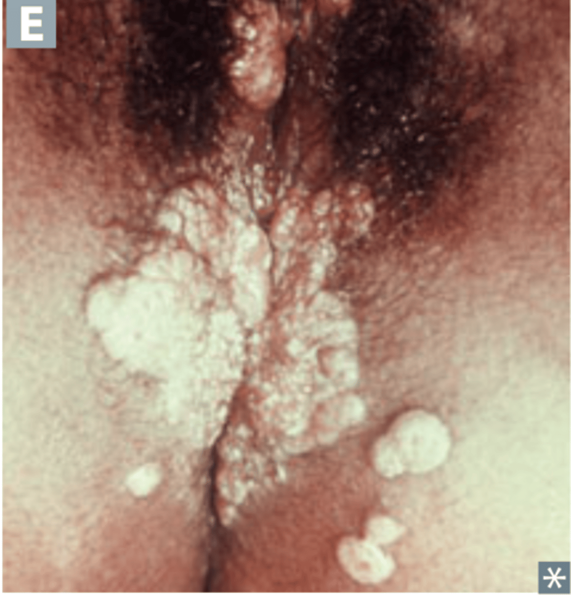 <p>Wart-like lesions on the arms and genitals</p><p>Associated with secondary syphilis infection.</p>