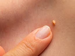 <ul><li><p>alcohol intolerance</p></li><li><p>infections</p></li><li><p>discolaration</p></li><li><p>papilloma:benign, non-cancerous tumor that grows on an epithelial surface</p></li><li><p>premature delivery (lipophillic=&gt; crosses the barrier)</p></li><li><p>hyperkalaemia</p></li></ul><p></p>