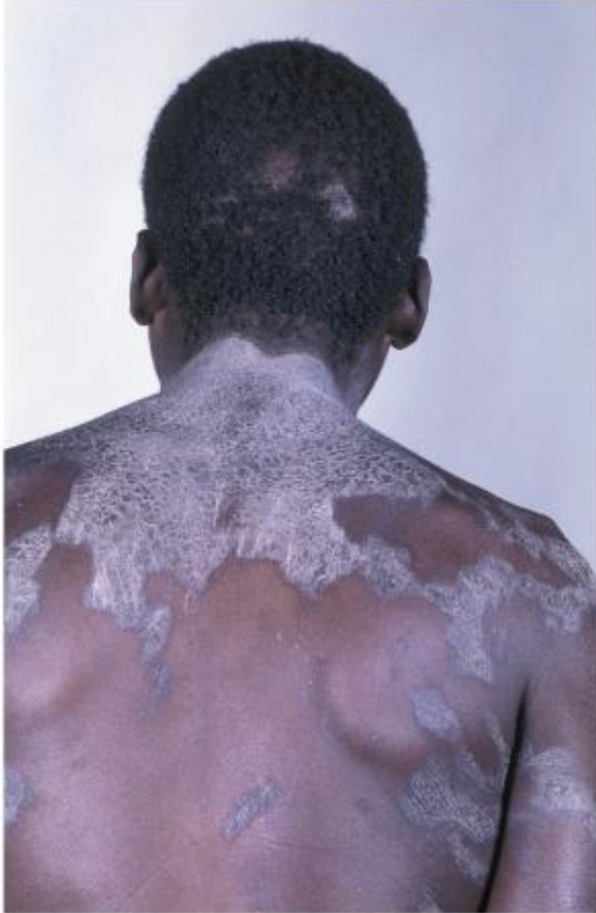 <p>Results in Pellagra(Angry skin) which has symptoms of diarrhea, dermatitis, dementia, and death(4Ds)</p><ul><li><p>Humans can synthesize niacin from tryptophan when protein requierments have been met</p></li></ul><p></p>