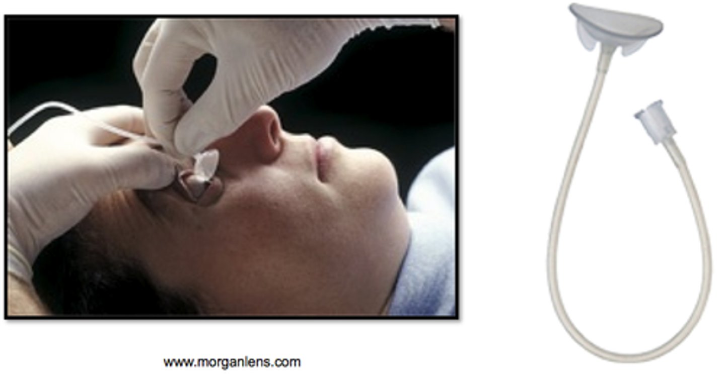 <p>continuous irrigation of the eye with sterile water or saline ONLY after chemical injury. do not use for mechanical injury</p>