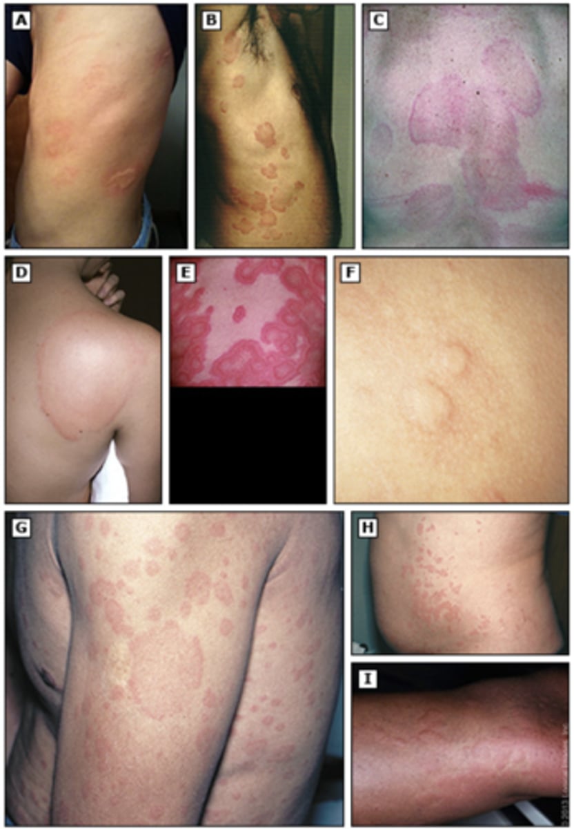 <p>Patient with a big blister on her hands. Question states it is itchy, red allergic reaction. What is it called?</p>
