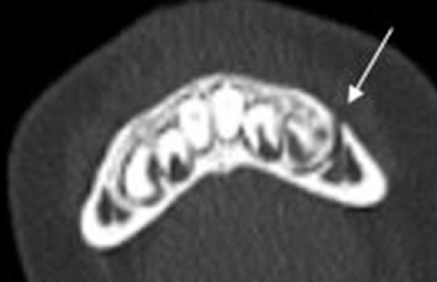 <p>A 4 year old female patient fell off her scooter and struck her face. She was wearing a helmet and had no loss of consciousness but reported pain in her left lower jaw. She went to her local Children's Hospital where a CT was taken showing this injury. What type of fracture is this?</p><p>- Simple</p><p>- Comminuted</p><p>- Greenstick</p><p>- Complex</p>