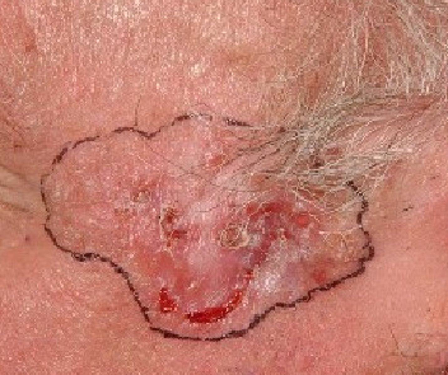 <p>Hoe heet dit klinisch beeld (tip: atrofie)</p>