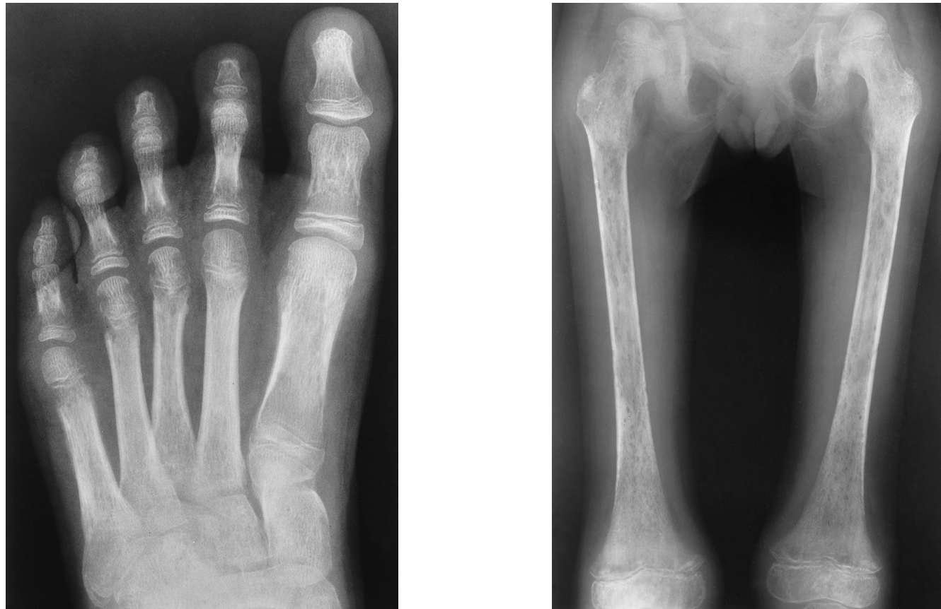<p>leukemia radiographically&nbsp;</p>