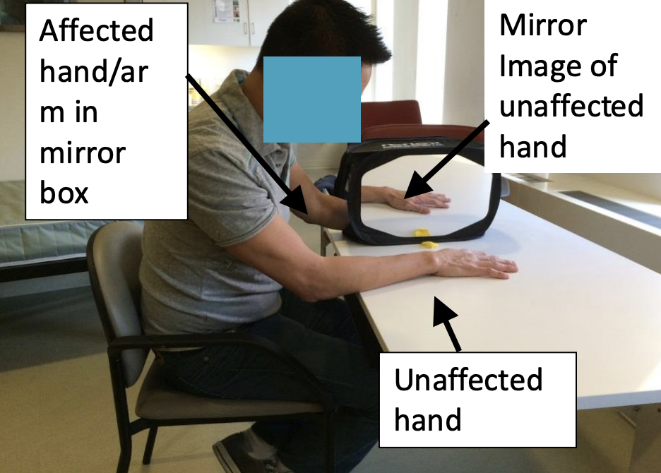 <ul><li><p>Mirror therapy is <strong><u>designed to improve limb and ADL function poststroke through visual feedback</u></strong></p></li><li><p>The <strong><u>visual feedback "tricks our brains" into thinking that the involved arm is moving (by looking at the mirror image of the unaffected hand)</u></strong></p></li><li><p>Why does it work?</p><ul><li><p>Not sure 100% but 3 theories</p><ul><li><p><strong><u>Increase attention to the affected side</u></strong></p></li><li><p><strong><u>Motor Neuron System</u></strong></p></li><li><p><strong><u>Motor system</u></strong></p></li></ul></li></ul></li></ul><p></p>