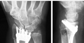 <p>A predictor of subsequent fractures in <strong>osteoporosis </strong>is a fracture of the ______.</p>