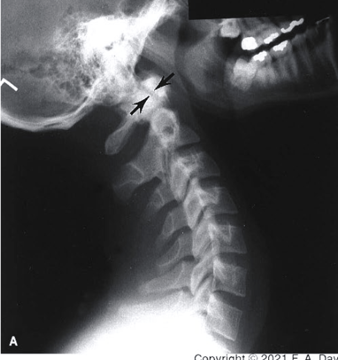 <p>what view is this?</p><p>a. extension stress</p><p>b. flexion stress</p><p>c. lateral</p><p>d. oblique</p>