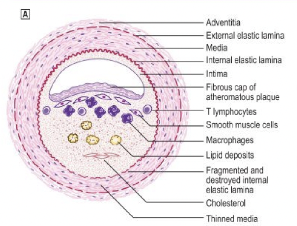 a lesion with a lipid core and fibrous cap covered by arterial endothelium