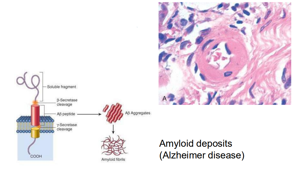<p>- abnormal products build up in the interstitium</p><p>- hyaline and/or fibrinoid deposits around blood vessels (acute hypertension) (in the diagram)</p>
