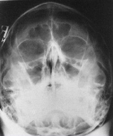 <p>What is this x-ray demonstrating?</p>