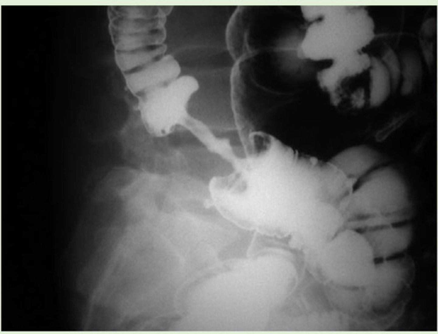 <p>Ulcerative colitis; caused by the stenosing of the colon</p>