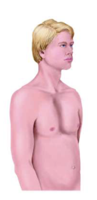 <p>abnormal, more dangerous because the sternum is tucked in and there’s pressure on the underlying organs </p>