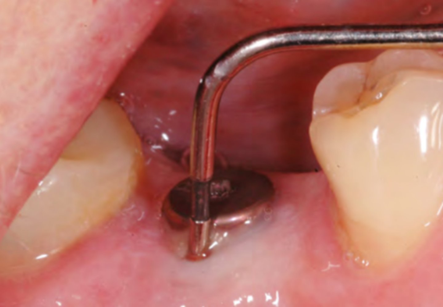<p>1. Radiographic examination of the implant using peri-apical radiographs to evaluate peri-implant bone levels compared</p><p>with the baseline radiograph; If clinically significant progressing crestal bone loss is detected, refer back to the clinician, who placed the implant. If this is not possible, carry out the following treatment:</p><p>2. Use the Oral Hygiene TIPPS behaviour change strategy to highlight the importance of effective plaque removal and to show the patient how he/she can achieve this. Encourage the use of oral hygiene aids such as implant floss and interdental brushes. Where applicable, give smoking cessation advice</p><p>3. Remove supra-mucosal and sub-mucosal plaque and calculus using an appropriate method. Remove sub-mucosal excess residual cement if this is detected. LA may be required. Highlight to the patient the areas where supra-mucosal deposits are detected.</p><p>4. Arrange a follow-up appointment after 1-2 months to assess the outcome of treatment. Re-examine the peri-implant tissues. Where there is no improvement or in the presence of</p><p>acute pain and infection, seek advice from secondary care. If the inflammation has settled and a stable situation has been achieved, arrange radiographic follow-up in 6-12 months</p>