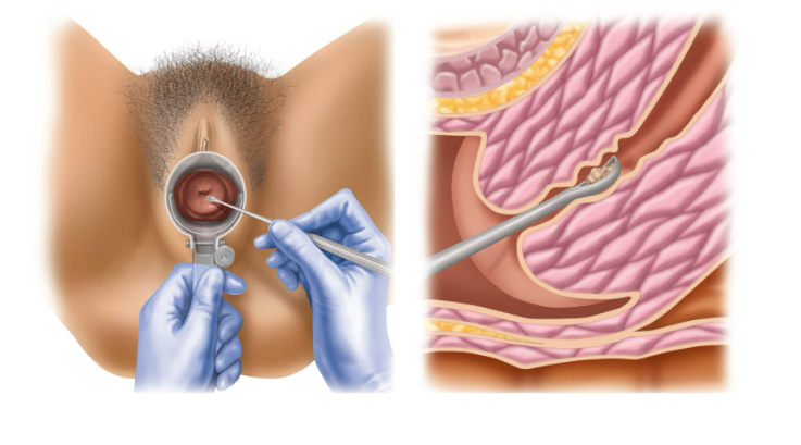 <p><span style="background-color: transparent;"><span>examines cells from the </span><u><span>cervix</span></u></span></p>