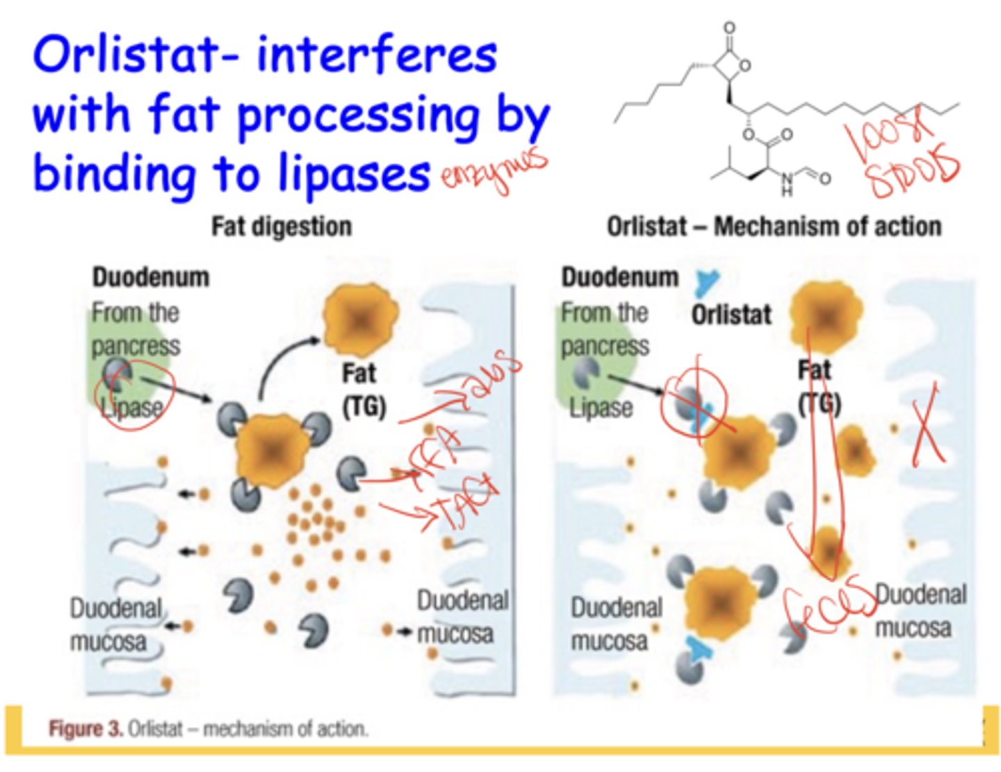 <p>inhibits GI lipases → prevents fat breakdown/absorption → fat excreted → causes oily loose stools as major side effect</p>