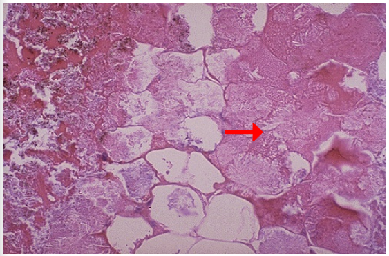 <p>1.Type of cell death</p><p>2.Necrotic fat cells are seen on which side?</p><p>3.describe its appearance </p>