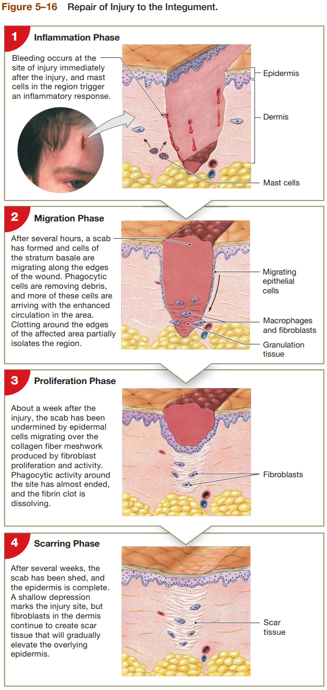 <p>Inflammation Phase</p><ul><li><p>bleeding occurs at site immediately after injury</p></li><li><p>mast cells in region trigger inflammatory response</p></li></ul><p>Migratory Phase</p><ul><li><p>scab will form after several hours, cells of stratum basal are migrating along edges of wound</p></li><li><p>phagocytic cells remove debris, and more arrive due to enhanced circulation of area</p></li><li><p>clotting around edges of affected area particularly isolates region</p></li></ul><p>Proliferation Phase</p><ul><li><p>after a week, scab has been undermined by epidermal cells migrating over collagen fiber meshwork produced by fibroblast proliferation &amp; activity</p></li><li><p>phagocytic activity around site has almost ended</p></li><li><p>fibrin clot is dissolving</p></li></ul><p>Scarring Phase</p><ul><li><p>after several weeks, scab shed and epidermis is complete</p></li><li><p>shallow depression marks injury sit, but fibroblasts in dermis continue to create scar tissue that will gradually elevate overlying epidermis</p></li></ul><p></p>