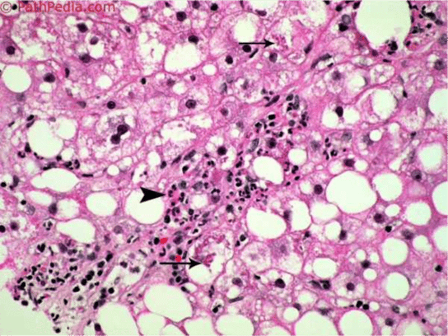 <p>Inflammation of the liver due to fat buildup</p>