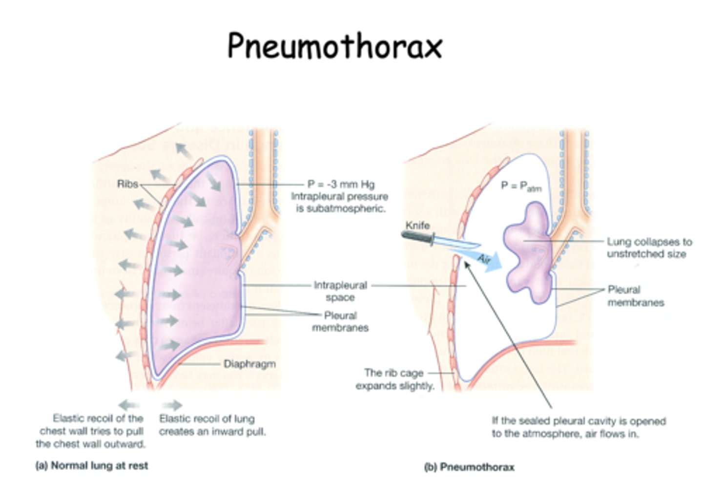 <p>pneumothorax</p>