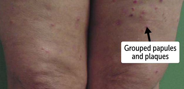 <p><span>symmetrically in groups over extensor surfaces such as shoulders, elbows, knees, and buttocks</span></p><ul><li><p>the lesions are <strong>fleshy or erythematous in color </strong></p></li><li><p>Patients will scratch lesions cause <strong>erosions and excoriations of the lesions</strong></p></li></ul><p></p>