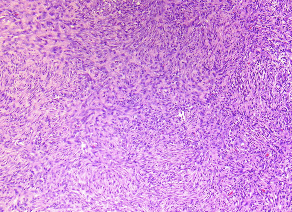 <p>Homme 16 ans nodule cervical</p><p>1)Diagnostic</p><p>2) macro</p><p>3) histo</p><p>4)IHC</p><p>5) Moléculaire</p>