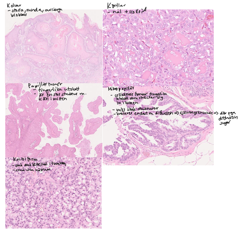 <p>Körtlar – glandulär växt; Papiller – fingerlika utskott; Kribriform – silformad struktur; Solida – utan struktur; Enskilda celler – spridda, t.ex. lobulär bröstcancer</p>