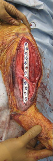 <p><span>There is no optimal method, but plates/screws and ESF are good choices, while casts/splints&nbsp;and pins/cerclage should be avoided.&nbsp;</span><br><br><span>ESF has many advantages, including stability&nbsp;with&nbsp;pins relatively distant from wounds, easy access to the wound, can be placed minimally invasively (decreased trauma to soft tissue), and implants can be removed once fracture is healed.</span></p>