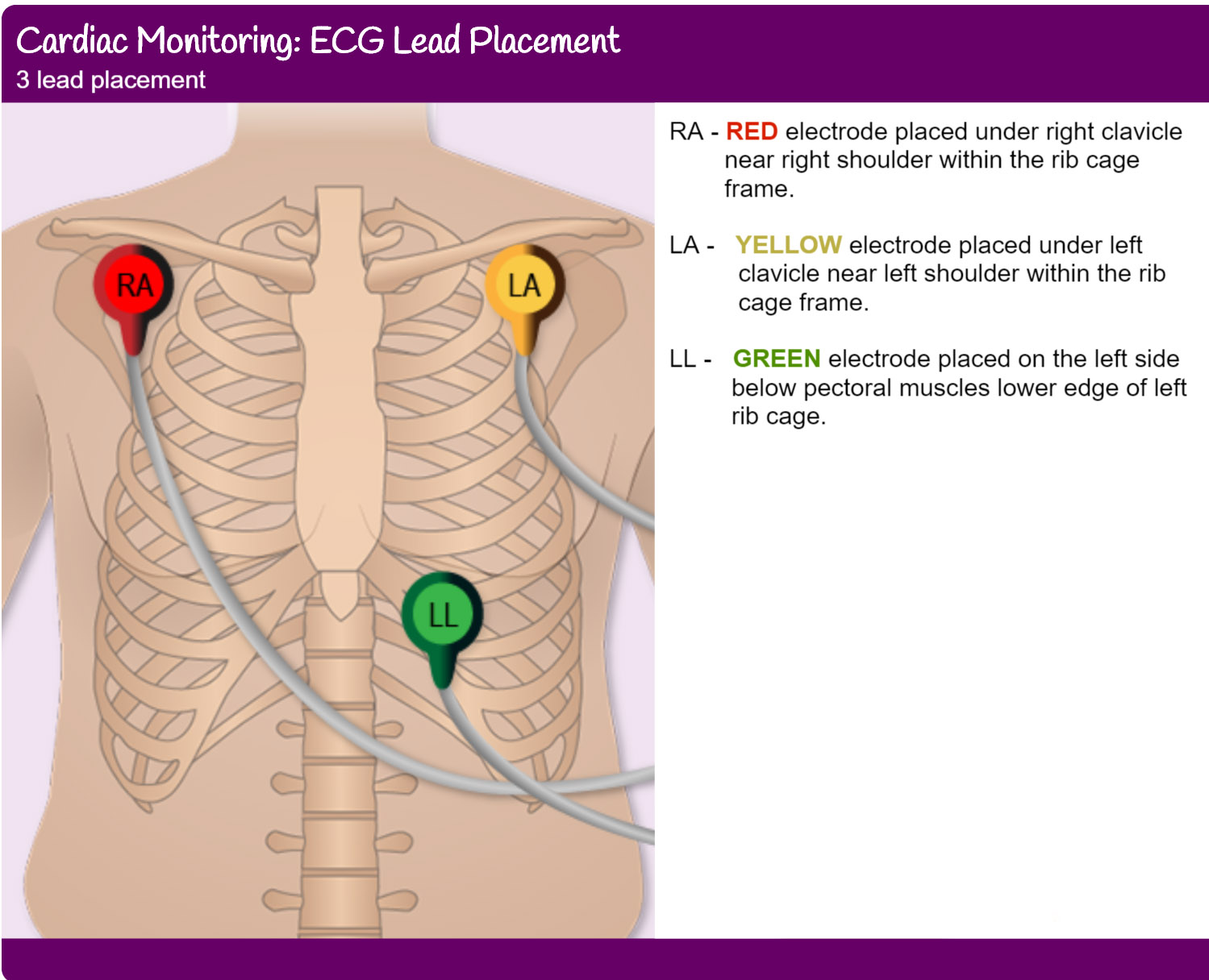 <p>what is the 3 lead ECGs and where are the electrode placed?</p>