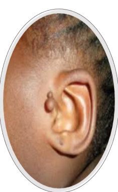 <p>What is this disorder</p>