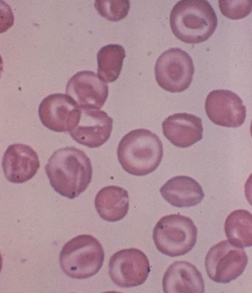 * Hb at the edges & center of the cell
* (Codocytes)
* causes: Hepatopathy, Iron deficiency