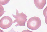 <p>Abetalipoproteinemia, <strong><mark data-color="yellow" style="background-color: yellow; color: inherit;">alcoholic liver disease,</mark></strong> disorders of lipid metabolism, post-splenectomy - need to know yellow </p>