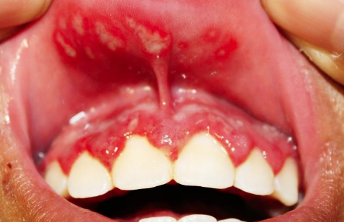 <p>What is the clinical presentation of primary herpetic gingivostomatitis? Intraoral?</p>