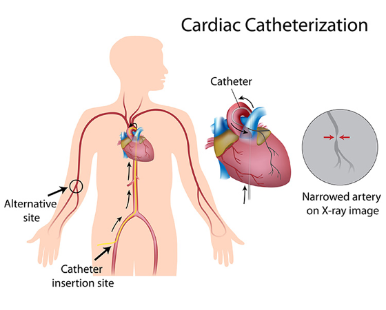 <p><span style="font-family: Calibri">Diagnostic procedure performed by passing a catheter into the heart from a from a blood vessel in the groin or arm </span>to examine the condition of the heart and surrounding blood vessels; used to diagnose and treat cardiovascular conditions such as coronary artery disease</p>