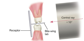 <p>Increase vertical angulation by about +10° to correct for plate bending and keep contacts open.</p>