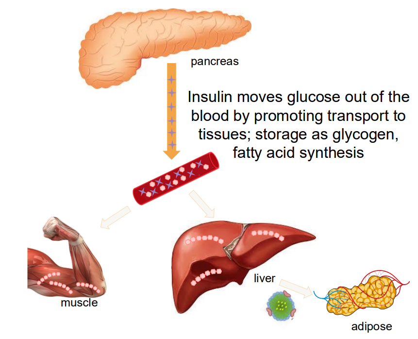 <p>TYPE 1: INSUFFICIENT PRODUCTION OF INSULIN</p><p>- autoimmune destruction of beta cells</p><p>- usually develops early in life</p><p>- previously known as: insulin-depdendent diabetes, juvenile diabetes</p><p>- 10-15% of all diabetic cases</p><p>.</p><p>TYPE 2: INSULIN RESISTANCE:</p><p>- usually develops in late adulthood</p><p>- associated with obesity</p><p>- cells don't respond appropriately to insulin</p>
