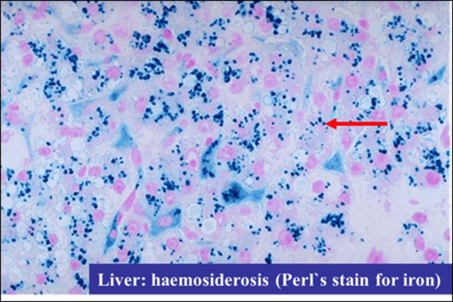 <p>Iron overload</p><p>An overload of iron in the body resulting from repeated blood transfusions. Hemosiderosis occurs most often in patients with thalassemia.</p><p>Abnormal deposit of hemosiderin</p>