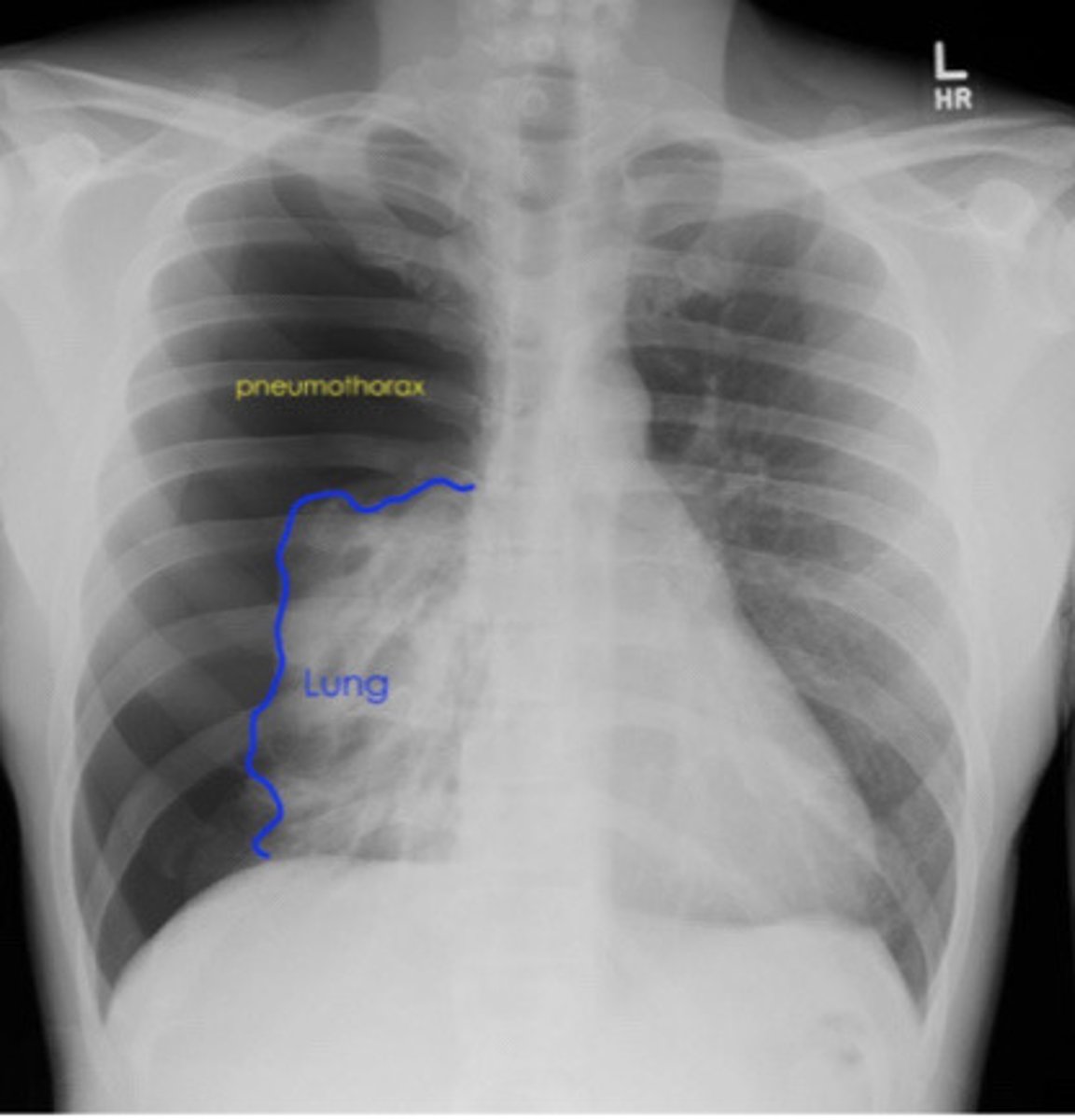 <p>Pneumothorax</p>