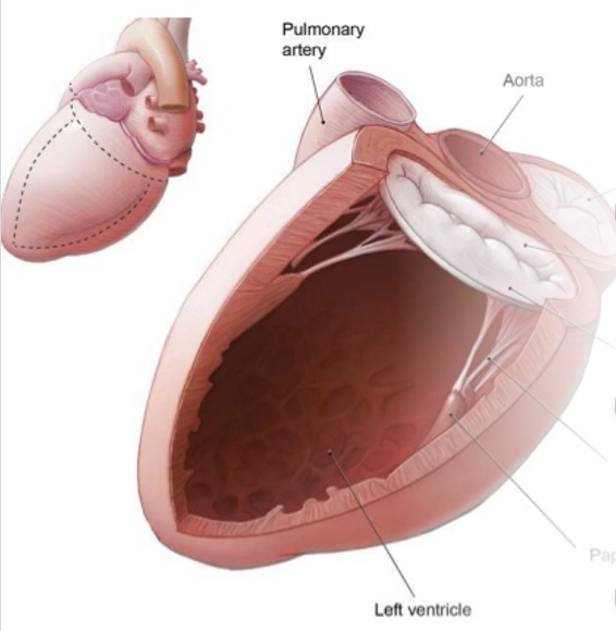 <p><span>•The mitral valve acts as a gate between the left atrium and the left ventricle; the leaflets open and close as the heart beats and act as a 1-way valve.</span></p><p><span>•Any abnormalities with the _____________can lead to mitral regurgitation.</span></p>