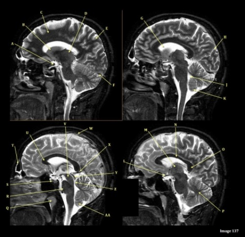 <p>Letter N in Image 137 is pointing to:</p><p>A. Pons</p><p>B. Cerebral peduncle</p><p>C. Genu of corpus callosum</p><p>D. Body of corpus callosum</p><p>E. Splenium of corpus callosum</p>
