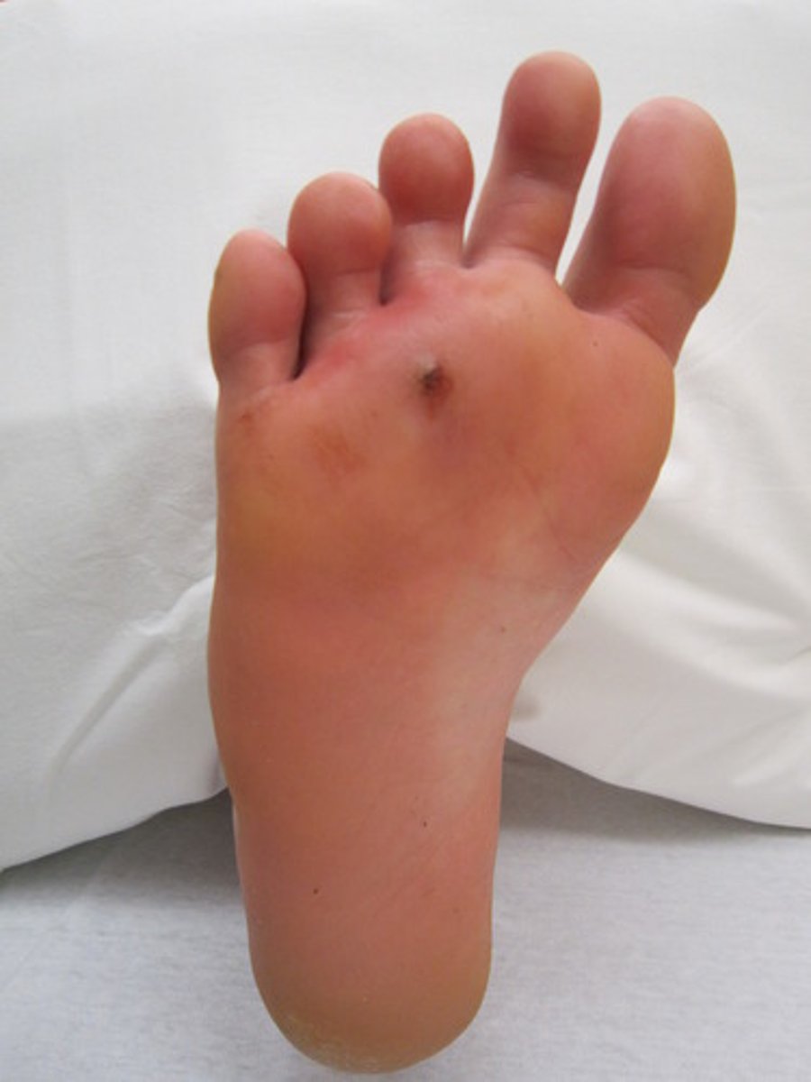<p>when skin is pierced with a pointed object</p>