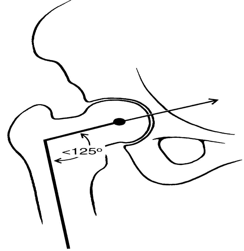 <p>angle of femur and pelvis articulation</p>