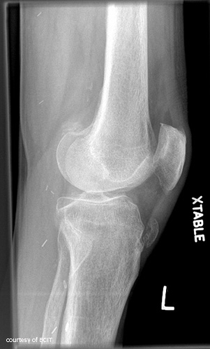 <p>What causes tibial tuberosity avulsion fractures?</p>