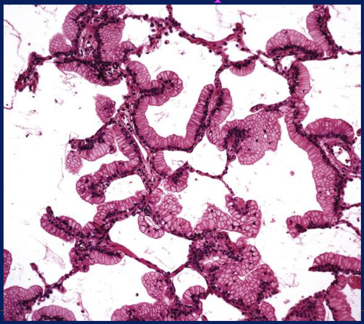 <p>Patrón de adenocarcinoma</p>
